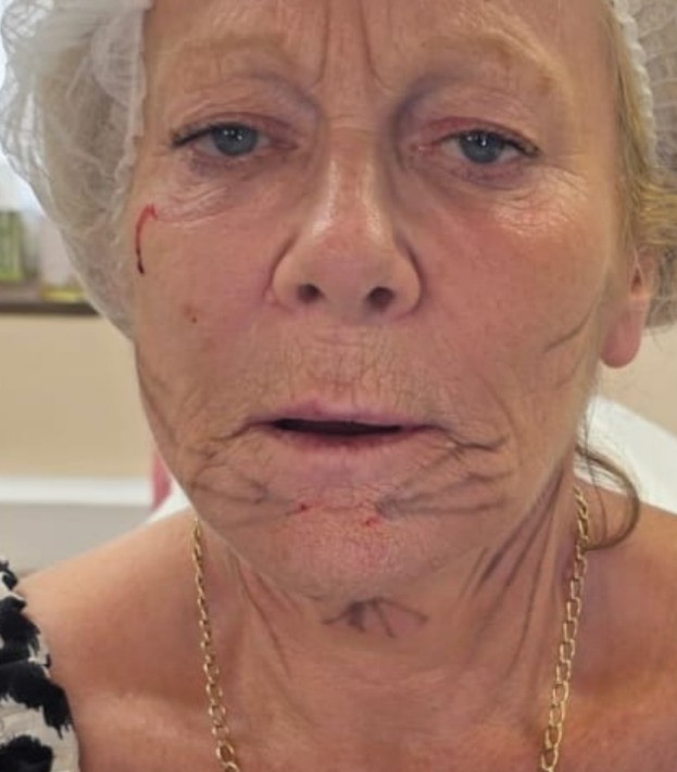 EndoPulse — Lower face, on the day