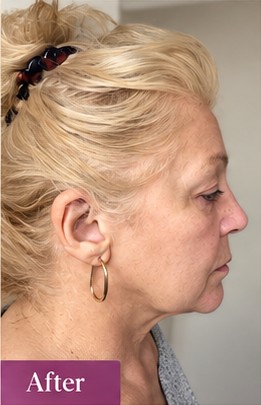 EndoPulse — Profile — after