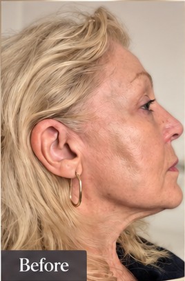 EndoPulse — Profile — before